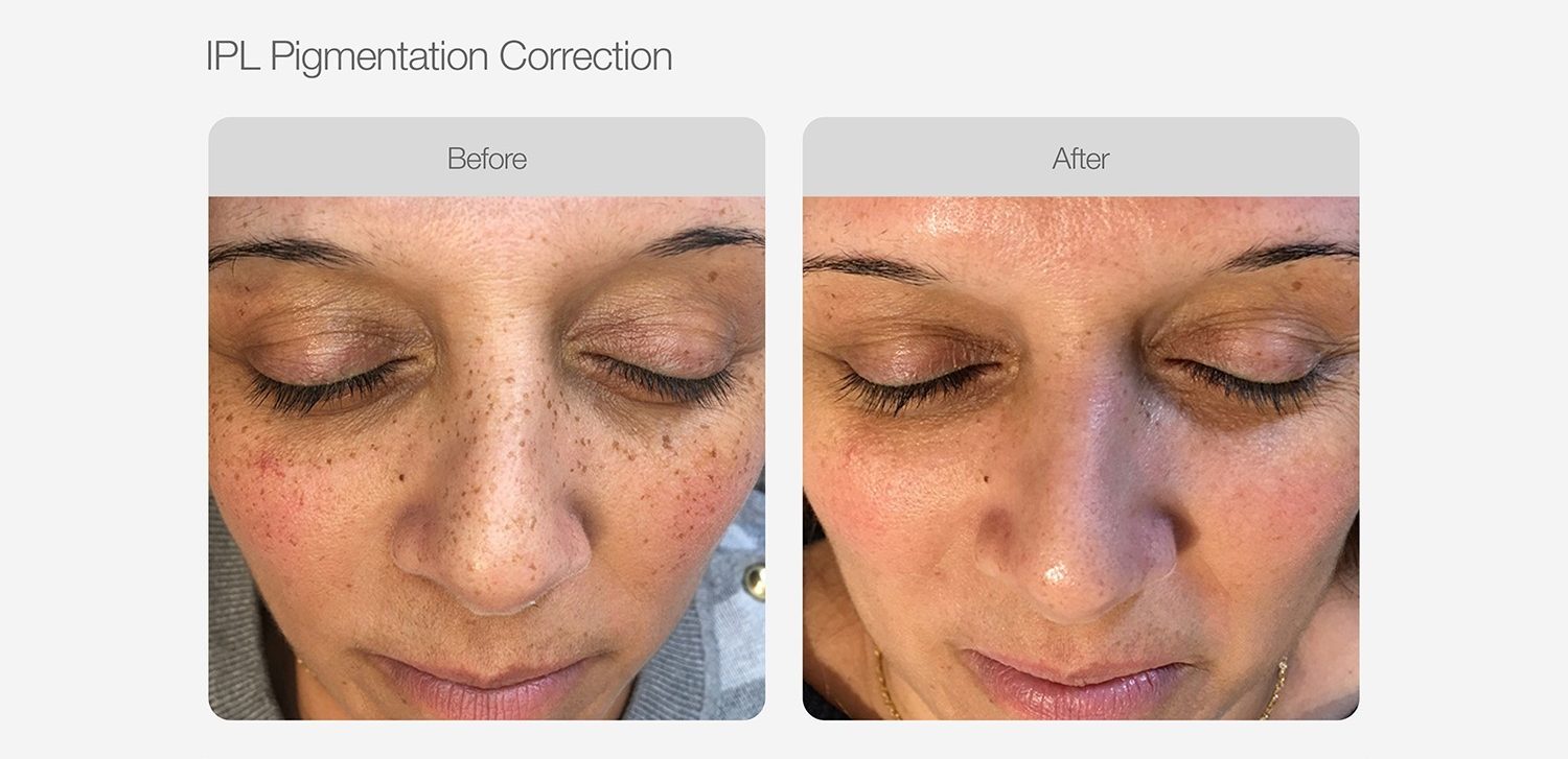 IPL Pigmentation Correction Before & After