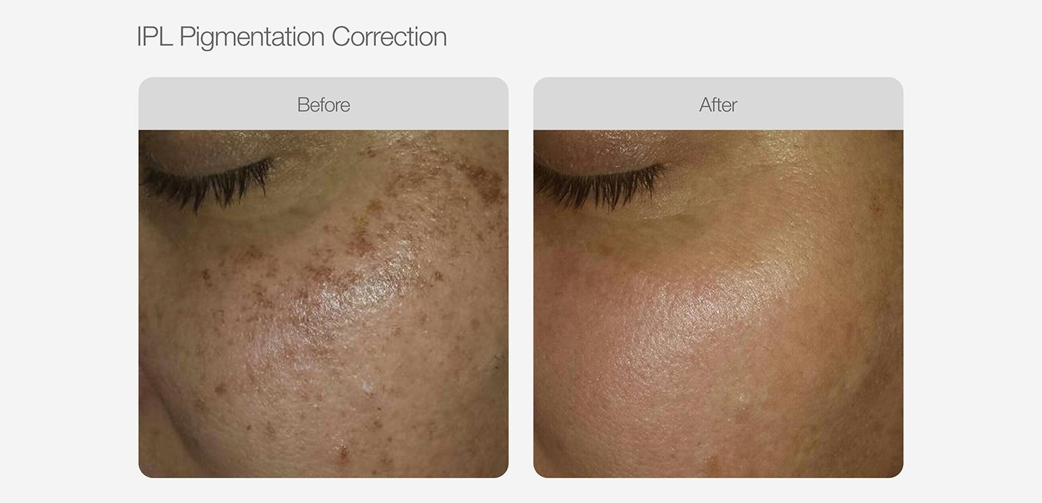 IPL Pigmentation Correction Before & After