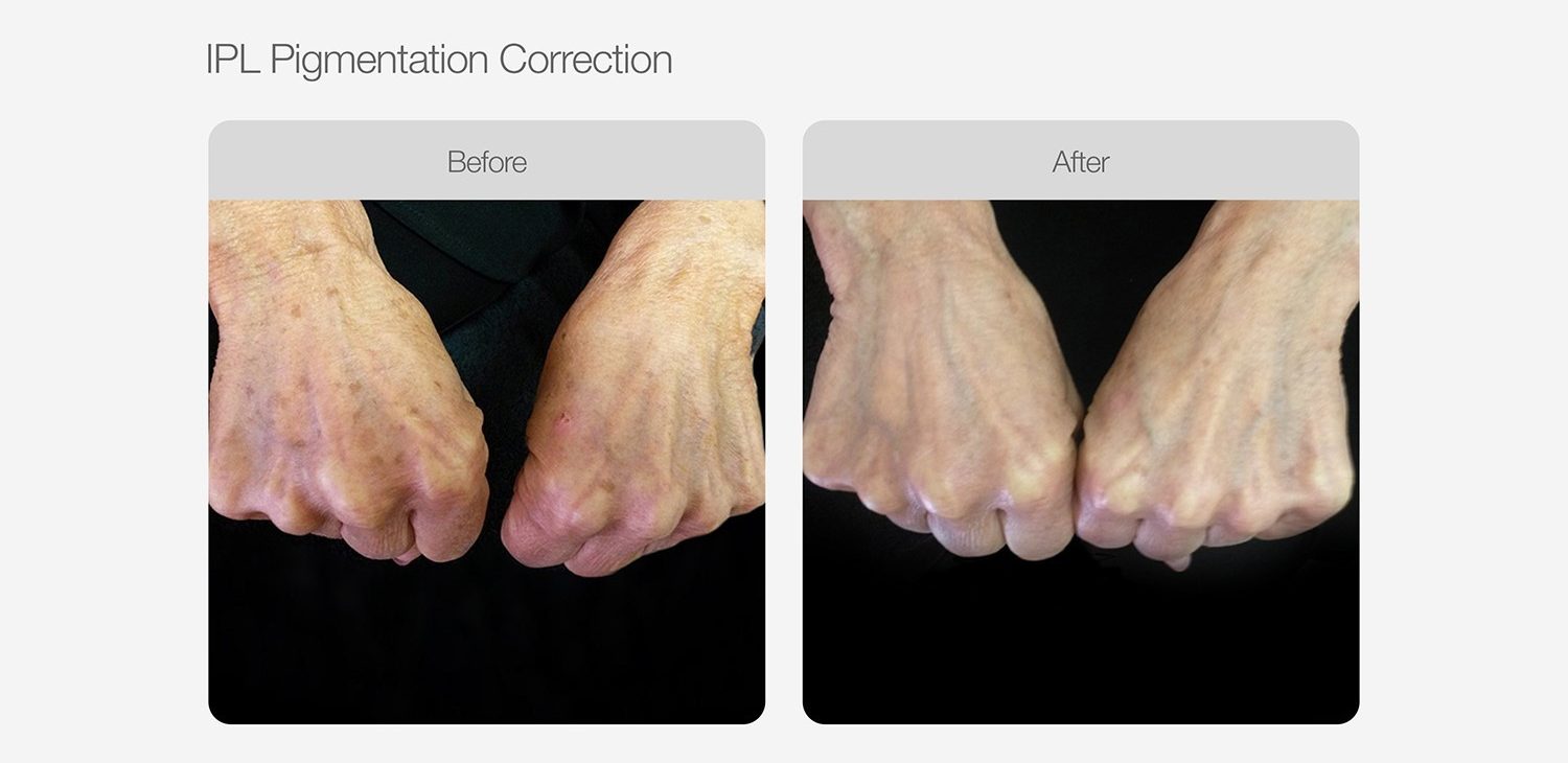 IPL Pigmentation Correction Before & After