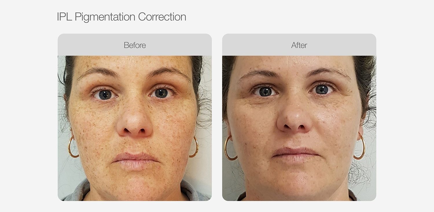 IPL Pigmentation Correction Before & After