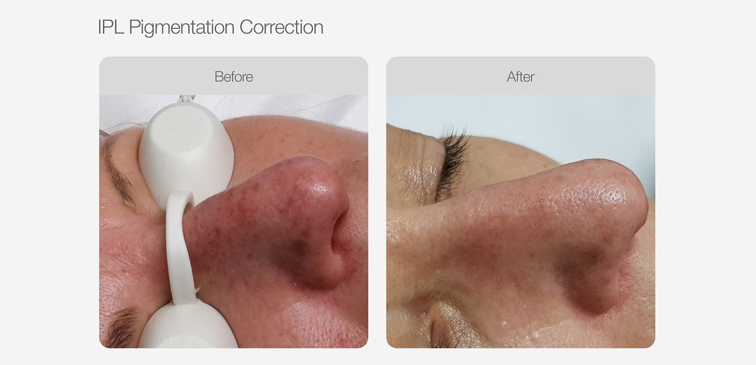 IPL Pigmentation Correction Before & After